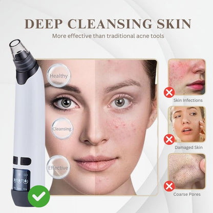 Blackhead Remover Pore Vacuum Cleaner