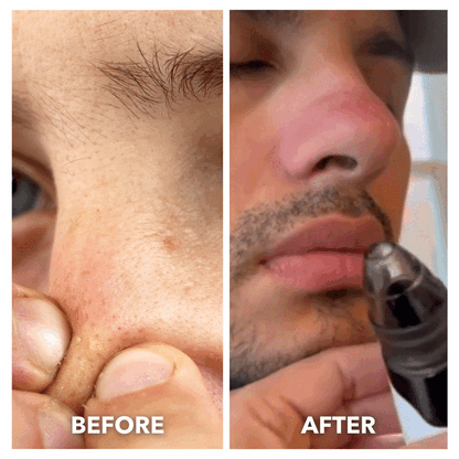 Blackhead Remover Pore Vacuum Cleaner