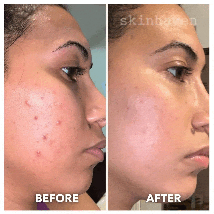 Face Mask Light Therapy Gen.2