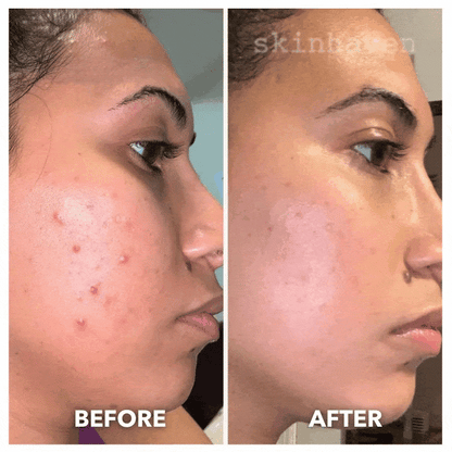 Face Mask Light Therapy Gen.2