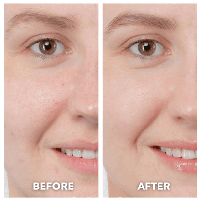 ThermaLift 5-in-1 Facial Sculptor & Cleanser Device